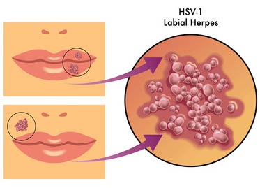 Lippenherpes