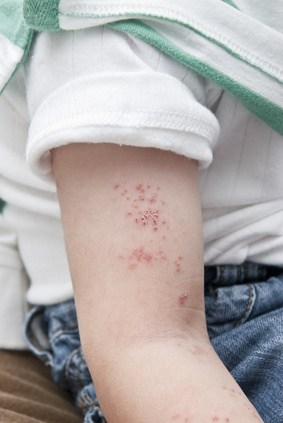 Kleinkind herpes am arm