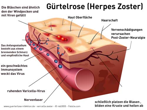 An der scheide herpes Cockplus