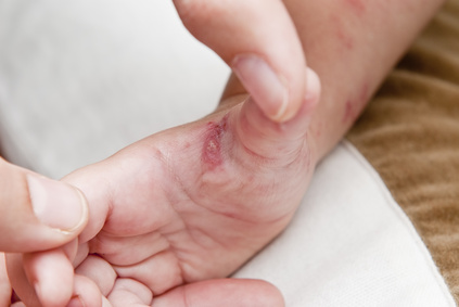 herpes ansteckend wie lange