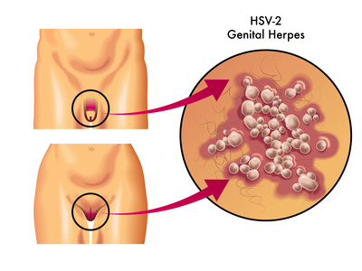 Genitalis symptome herpes Herpes Symptoms