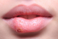 herpes stadien