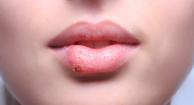 Herpes-Simplex