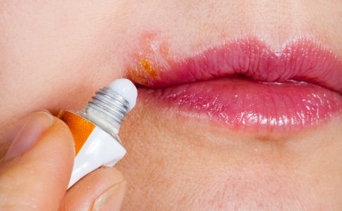 Herpesbläschen Behandeln Herpesbläschen Behandeln