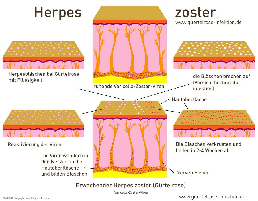 Krankheitsverlauf der Gürtelrose