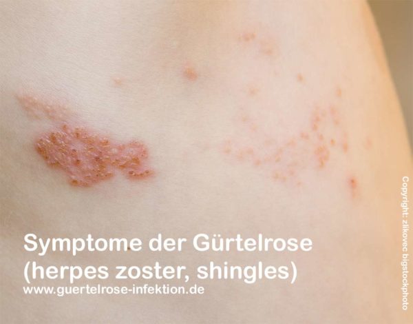 Gesichtsrose Symptome, Behandlung, Komplikationen bei Gürtelrose im
