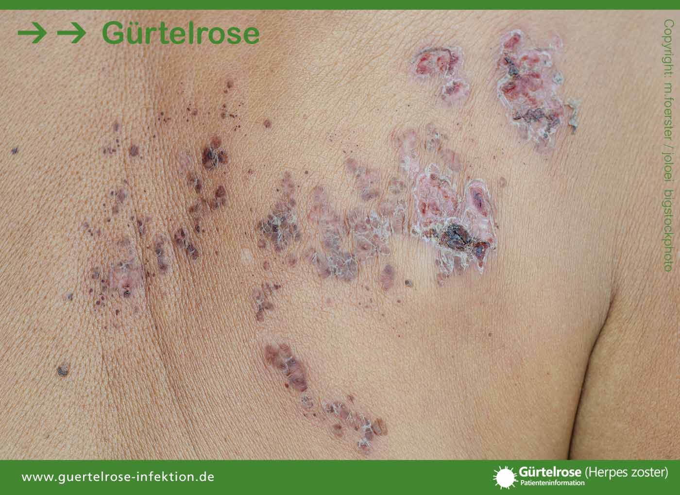 Gürtelrose (Herpes zoster)