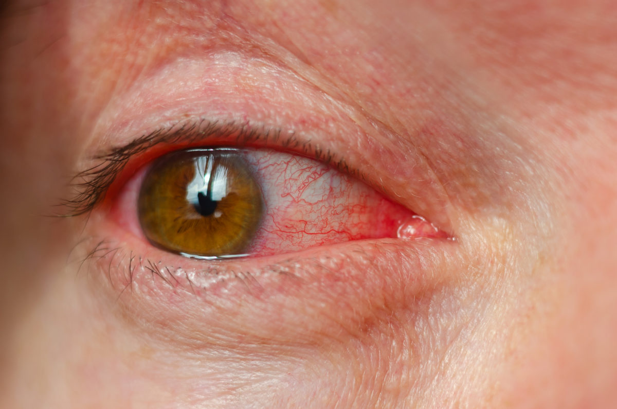 Konjunktivitis nach Gürtelrose